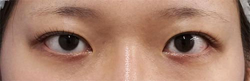 目頭切開（Z形成）、右切らない眼瞼下垂　３か月後のBefore写真