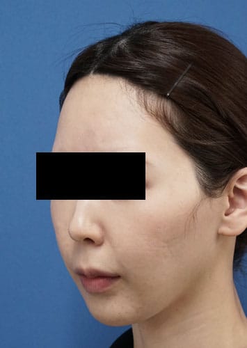 ヒアルロン酸（額・こめかみ）　１週間後　左斜めのBefore写真