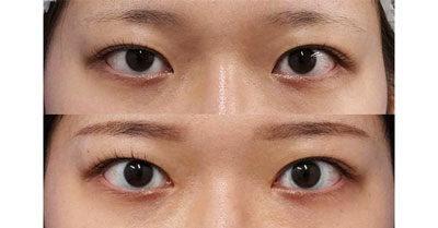 目頭切開（Z形成）、右切らない眼瞼下垂　３か月後