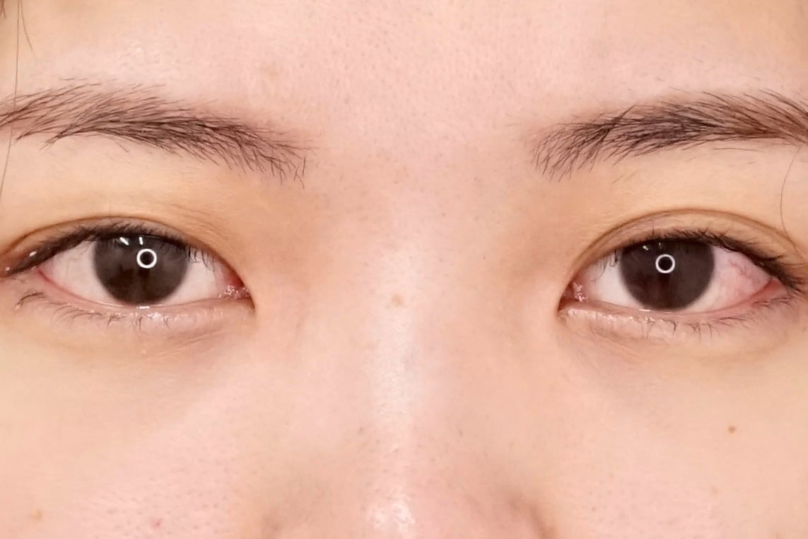 目の下の脂肪取り、コンデンス脂肪注入1か月後のAfterの写真