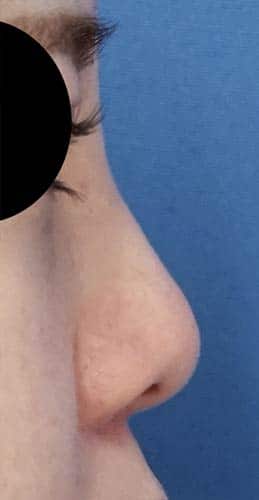 鼻尖縮小、軟骨移植　６か月後　右側面のAfterの写真