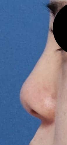鼻尖縮小、軟骨移植　６か月後　左側面のBefore写真