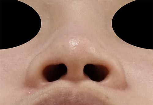 鼻翼縮小(内＋外)、鼻尖縮小(3D法)＋軟骨移植＋ストラット　３か月後　下からのBefore写真