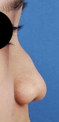鼻尖縮小（３D法）、ストラット、鼻プロテーゼ　３か月後　右側面のBefore写真
