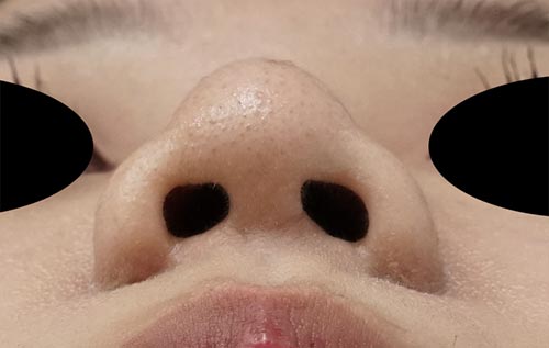 鼻尖縮小（３D法）、ストラット、鼻プロテーゼ　３か月後　下からのAfterの写真