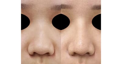 鼻尖縮小（３D法）、ストラット、鼻プロテーゼ　３か月後