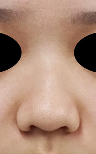 鼻尖縮小（３D法）、ストラット、鼻プロテーゼ　３か月後　正面のBefore写真