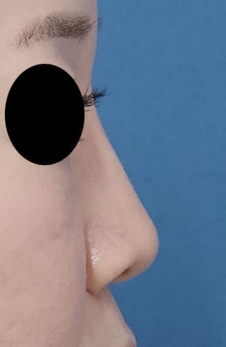 ジュビダームボラックス（鼻根）　１週間後　右側面のAfterの写真