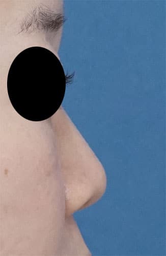ジュビダームボラックス（鼻根）　１週間後　右側面のBefore写真