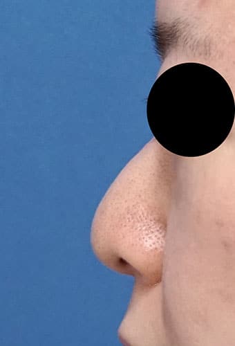 鼻尖縮小、鼻中隔延長、プロテ―ゼ、鼻翼縮小（内側＋外側）　１か月後　左側面のBefore写真