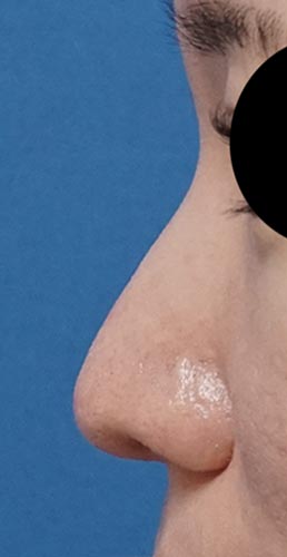 オステオポール除去、鼻尖縮小、ストラット、軟骨移植　３か月後　左側面のAfterの写真