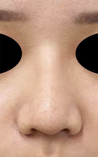 鼻尖縮小（３D法）、ストラット、鼻プロテーゼ　３か月後　正面のAfterの写真