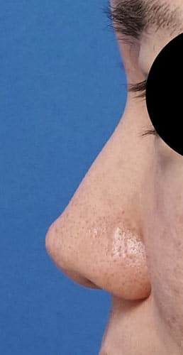 オステオポール除去、鼻尖縮小、ストラット、軟骨移植　３か月後　左側面のBefore写真