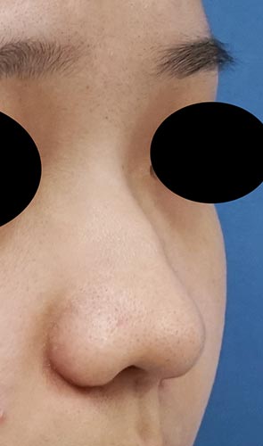 鼻尖縮小（３D法）、ストラット、鼻プロテーゼ　３か月後　右斜めのBefore写真
