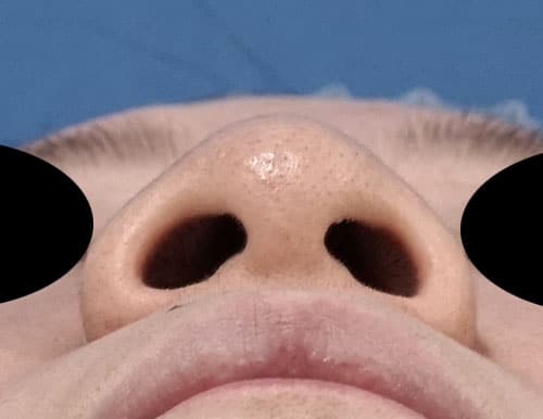 鼻尖縮小、鼻中隔延長、プロテ―ゼ、鼻翼縮小（内側＋外側）　１か月後　下からのBefore写真