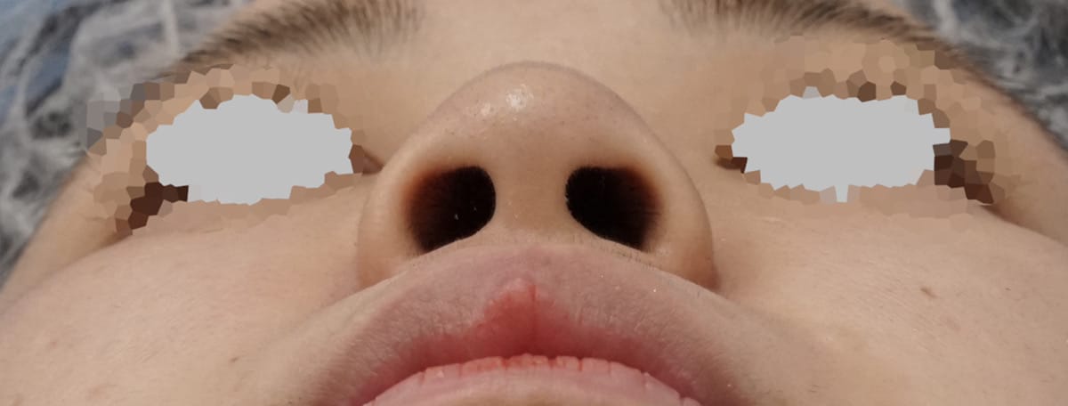 MISKOによる鼻先延長術1週間後のBefore写真