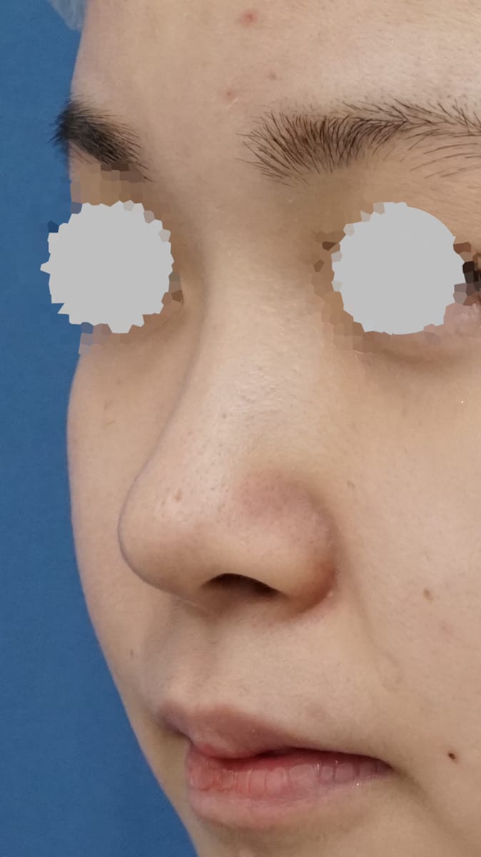 MISKOによる鼻先延長術1週間後のBefore写真