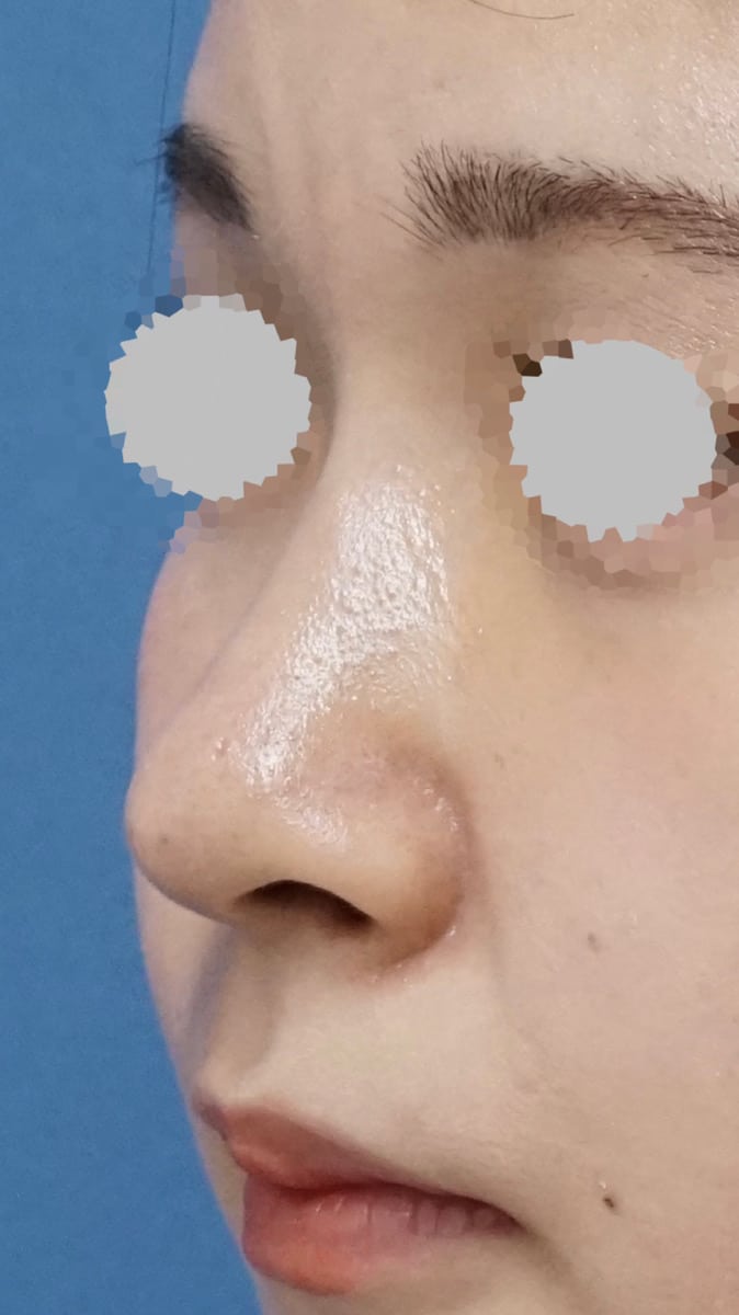 MISKOによる鼻先延長術1週間後のAfterの写真
