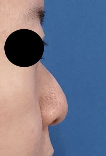 鼻尖縮小、鼻中隔延長、プロテ―ゼ、鼻翼縮小（内側＋外側）　１か月後　右側面のBefore写真