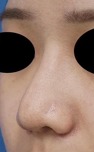 鼻尖縮小（３D法）、ストラット、鼻プロテーゼ　３か月後　左斜めのAfterの写真