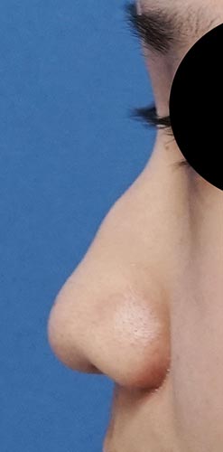 鼻尖縮小（３D法）、ストラット、鼻プロテーゼ　３か月後　左側面のBefore写真