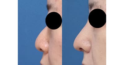鼻尖縮小、鼻中隔延長、プロテ―ゼ、鼻翼縮小（内側＋外側）　１か月後