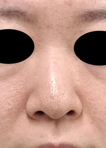 鼻尖縮小、鼻中隔延長、プロテ―ゼ、鼻翼縮小（内側＋外側）　１か月後　正面のBefore写真