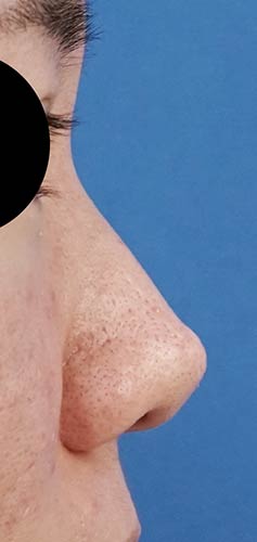 オステオポール除去、鼻尖縮小、ストラット、軟骨移植　３か月後　右側面のBefore写真