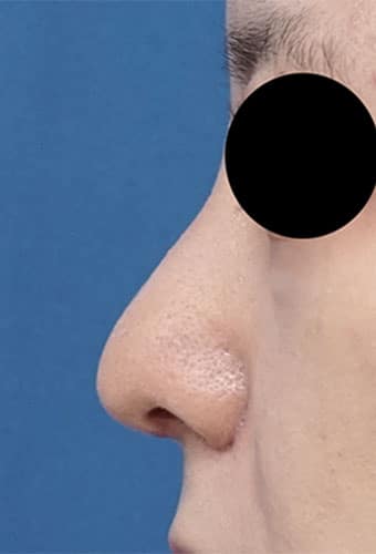 鼻尖縮小、鼻中隔延長、プロテ―ゼ、鼻翼縮小（内側＋外側）　１か月後　左側面のAfterの写真