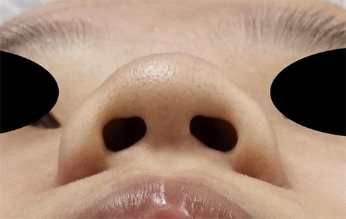 鼻尖縮小（３D法）、ストラット、鼻プロテーゼ　３か月後　下からのBefore写真