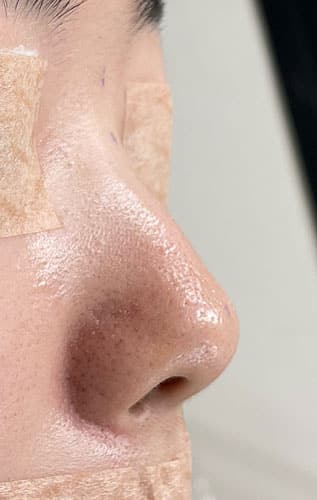 鼻中隔延長、鼻尖縮小、I型プロテー　右側面のBefore写真
