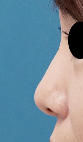 鼻尖縮小（３D法）、鼻翼縮小（内側法・FLAP法）　６か月後　左側面のAfterの写真
