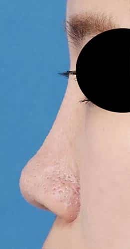 鼻ヒアルロン酸（クレヴィエルコントア）　１週間後　左側面のAfterの写真