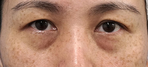 目の下くまとり手術（裏ハムラ法）　1か月後のBefore写真