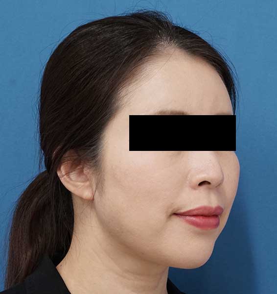 小顔脂肪吸引（ホホ・アゴ下）　６か月後　右斜めのAfterの写真