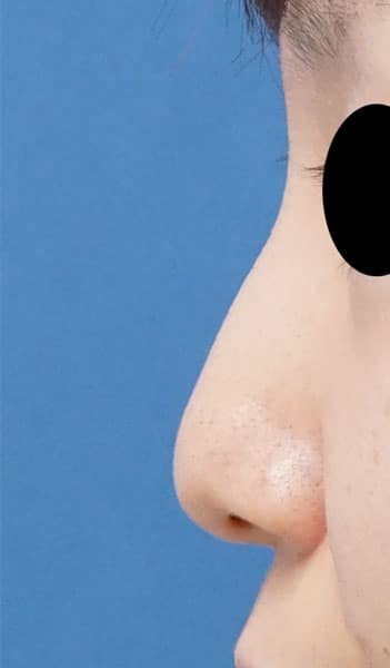 鼻尖縮小（３D法）、鼻翼縮小（内側法・FLAP法）　６か月後　左側面のBefore写真