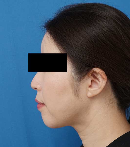 小顔脂肪吸引（ホホ・アゴ下）　６か月後　左側面のAfterの写真