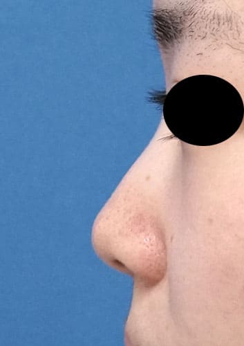 鼻尖縮小、鼻中隔延長、Ｉ型プロテーゼ　１か月後　左側面のBefore写真