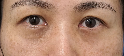 目の下くまとり手術（裏ハムラ法）　1か月後のAfterの写真