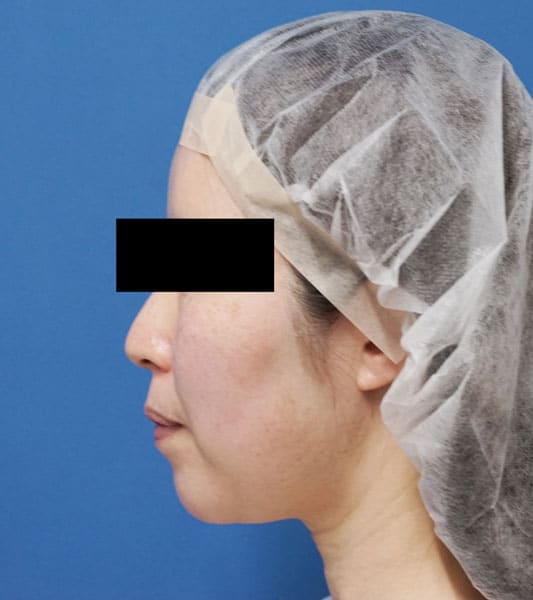 小顔脂肪吸引（ホホ・アゴ下）　６か月後　左側面のBefore写真