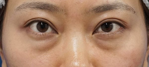 目の下脂肪取り、コンデンス脂肪注入　１０ヶ月後のBefore写真