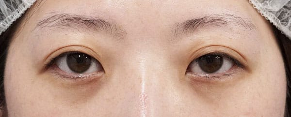 切らない眼瞼下垂プレミアム　３か月後のBefore写真