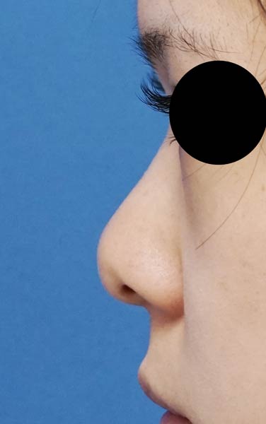 鼻尖縮小、耳介軟骨移植　６か月後　左側面のBefore写真