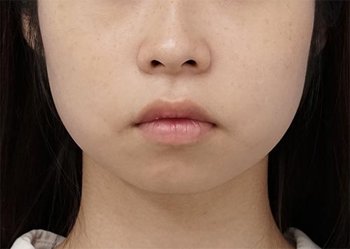 アゴヒアルロン酸（クレヴィエルコントア）　処置直後　正面のBefore写真