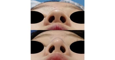 鼻尖縮小（３D法）、Ｉ型プロテーゼ　６か月後