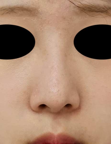 鼻尖縮小（３D法）、Ｉ型プロテーゼ　６か月後　正面のAfterの写真