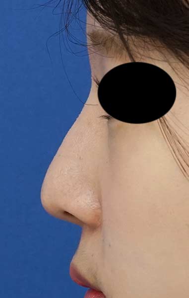 鼻尖縮小（３D法）、Ｉ型プロテーゼ　６か月後　左側面のAfterの写真