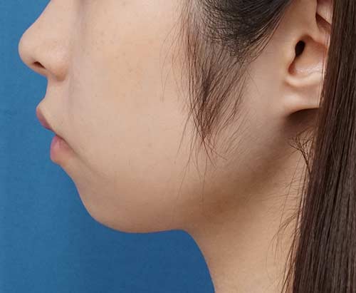 アゴヒアルロン酸（クレヴィエルコントア）　処置直後　左側面のBefore写真
