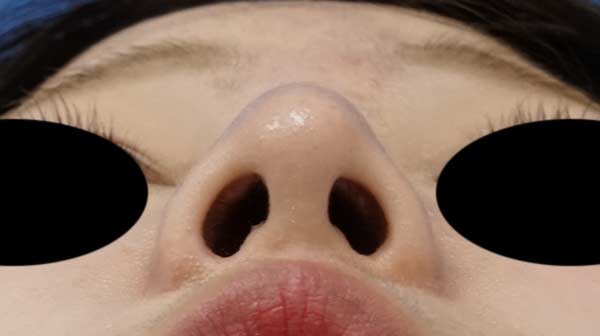 鼻尖縮小（３D法）、Ｉ型プロテーゼ　６か月後　下からのAfterの写真