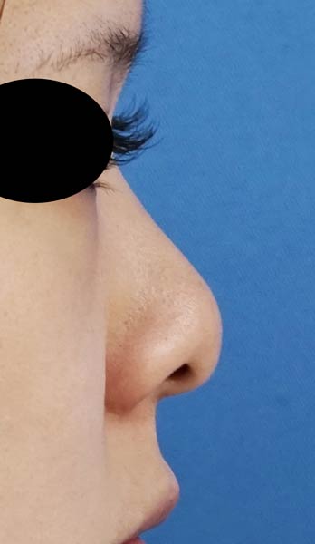 鼻尖縮小、耳介軟骨移植　６か月後　右側面のBefore写真